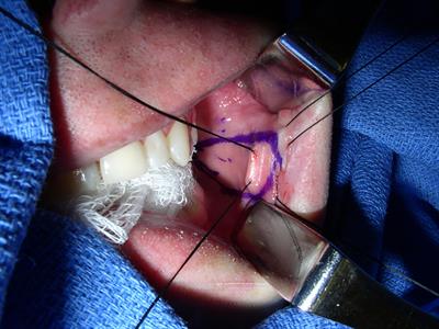 Buccal mucosa for use in urethral reconstruction: evolution of use over the last 30 years